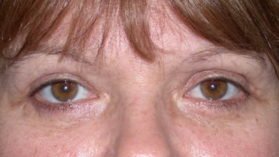 Eyelid Lift Gallery Before & After Gallery - Patient 4756937 - Image 2