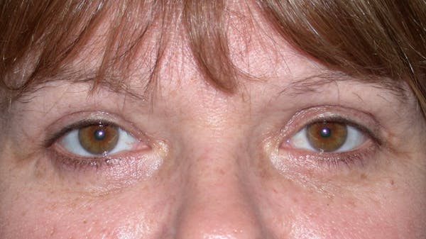 Eyelid Lift Gallery Before & After Gallery - Patient 4756937 - Image 2