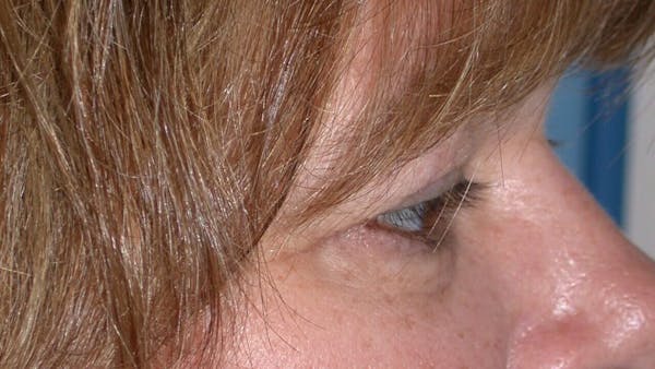 Eyelid Lift Gallery Before & After Gallery - Patient 4756937 - Image 3
