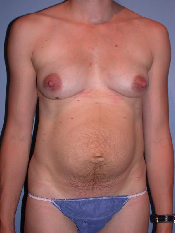 Tummy Tuck Before & After Gallery - Patient 4756938 - Image 1