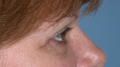 Eyelid Lift Gallery Before & After Gallery - Patient 4756937 - Image 4