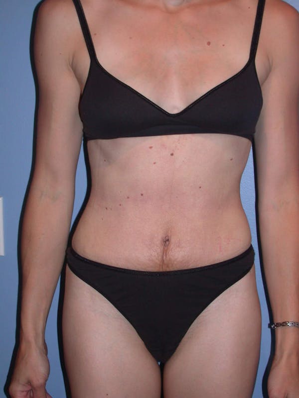 Tummy Tuck Gallery Before & After Gallery - Patient 4756938 - Image 2