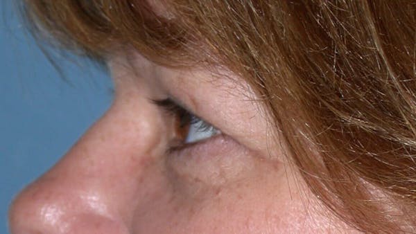 Eyelid Lift Gallery Before & After Gallery - Patient 4756937 - Image 5