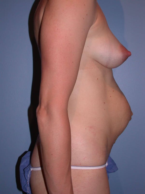 Tummy Tuck Gallery Before & After Gallery - Patient 4756938 - Image 3