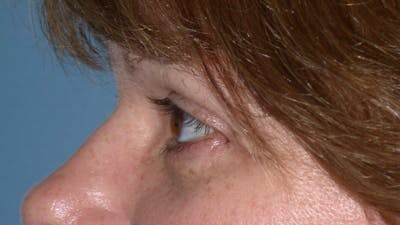Eyelid Lift Before & After Gallery - Patient 4756937 - Image 6