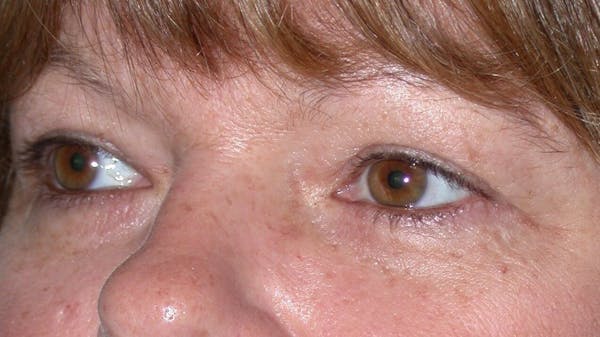 Eyelid Lift Gallery Before & After Gallery - Patient 4756937 - Image 7