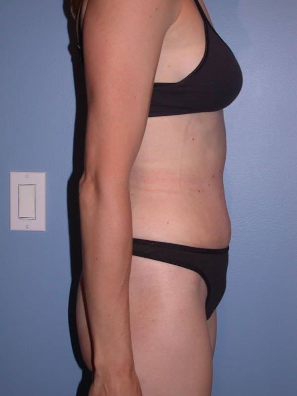 Tummy Tuck Gallery Before & After Gallery - Patient 4756938 - Image 4