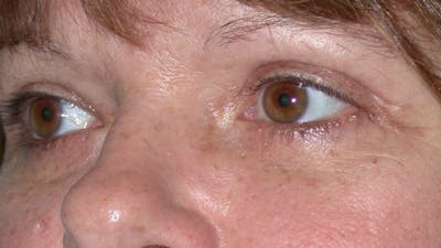 Eyelid Lift Gallery Before & After Gallery - Patient 4756937 - Image 8