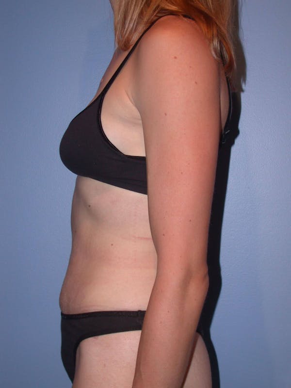 Tummy Tuck Gallery Before & After Gallery - Patient 4756938 - Image 6