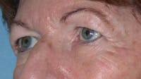 Eyelid Lift Gallery Before & After Gallery - Patient 4756940 - Image 1