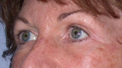 Eyelid Lift Gallery Before & After Gallery - Patient 4756940 - Image 2