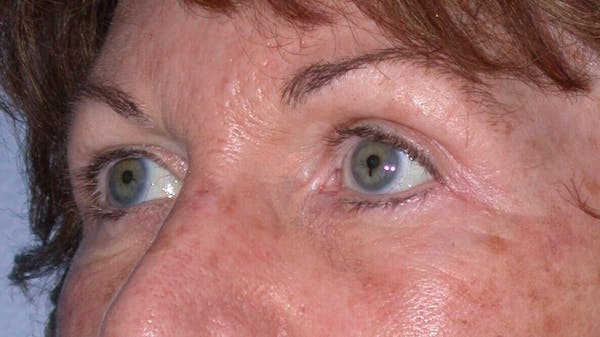 Eyelid Lift Gallery Before & After Gallery - Patient 4756940 - Image 2