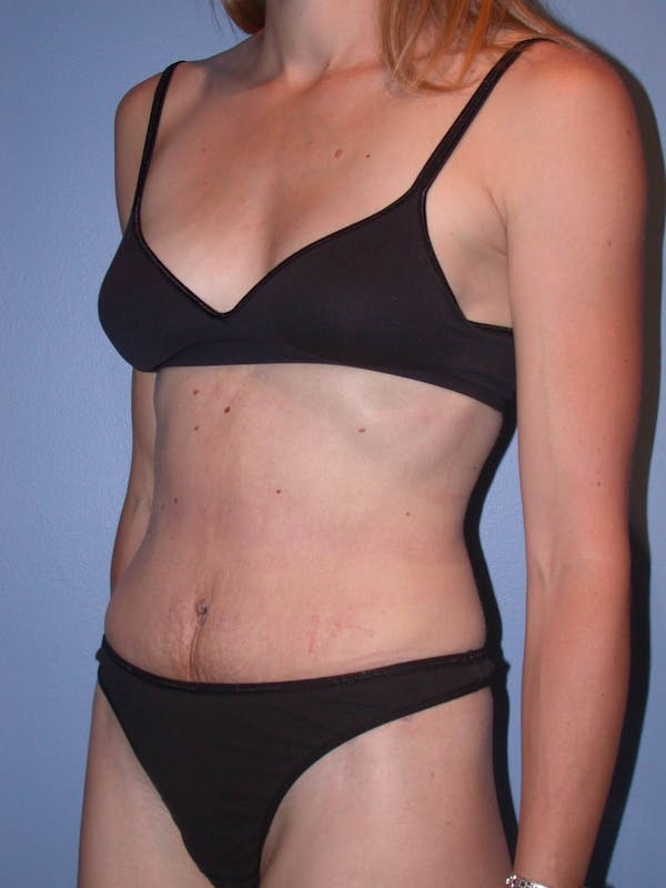 Tummy Tuck Gallery Before & After Gallery - Patient 4756938 - Image 8