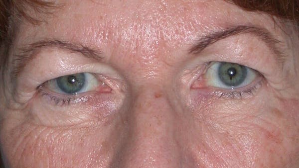 Eyelid Lift Gallery Before & After Gallery - Patient 4756940 - Image 3