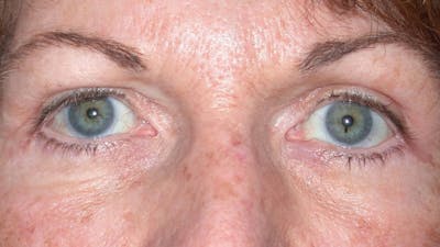 Eyelid Lift Gallery Before & After Gallery - Patient 4756940 - Image 4