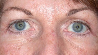Eyelid Lift Before & After Gallery - Patient 4756940 - Image 4