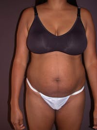 Tummy Tuck Gallery Before & After Gallery - Patient 4756942 - Image 1