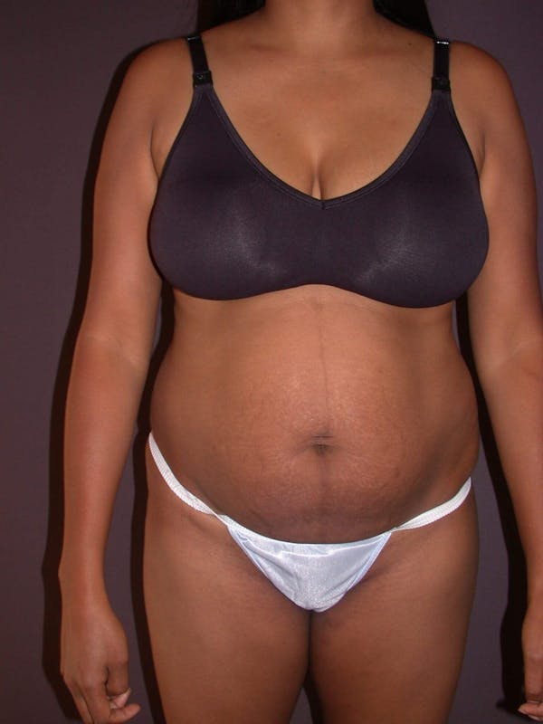 Tummy Tuck Gallery Before & After Gallery - Patient 4756942 - Image 1