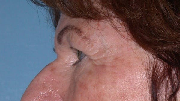 Eyelid Lift Gallery Before & After Gallery - Patient 4756940 - Image 5