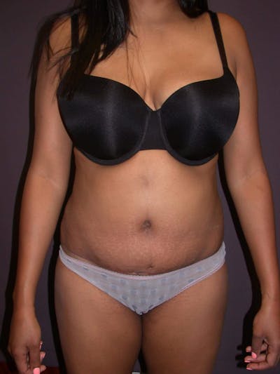 Tummy Tuck Gallery Before & After Gallery - Patient 4756942 - Image 2
