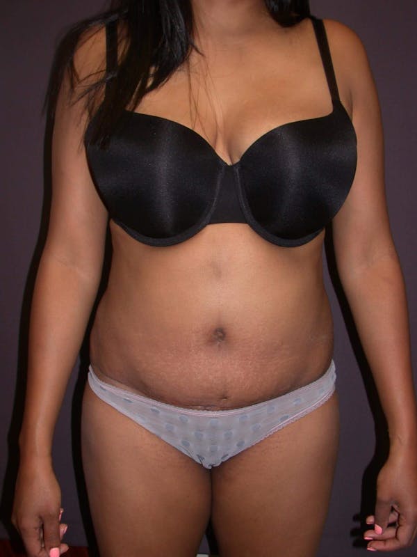 Tummy Tuck Before & After Gallery - Patient 4756942 - Image 2