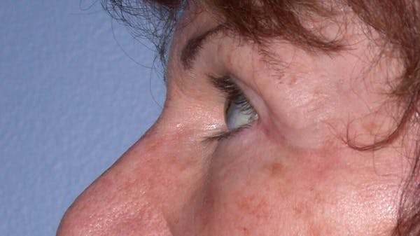 Eyelid Lift Gallery Before & After Gallery - Patient 4756940 - Image 6
