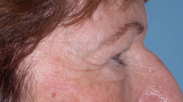 Eyelid Lift Gallery Before & After Gallery - Patient 4756940 - Image 7
