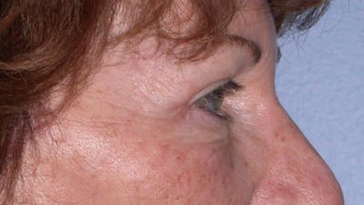 Eyelid Lift Gallery Before & After Gallery - Patient 4756940 - Image 8