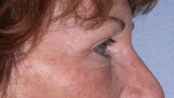 Eyelid Lift Gallery Before & After Gallery - Patient 4756940 - Image 8