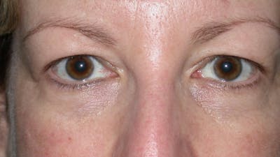Eyelid Lift Before & After Gallery - Patient 4756943 - Image 1