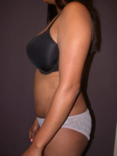 Tummy Tuck Before & After Gallery - Patient 4756942 - Image 6