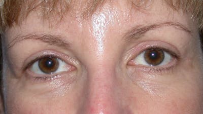Eyelid Lift Gallery Before & After Gallery - Patient 4756943 - Image 2