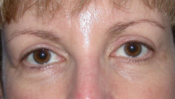 Eyelid Lift Before & After Gallery - Patient 4756943 - Image 2