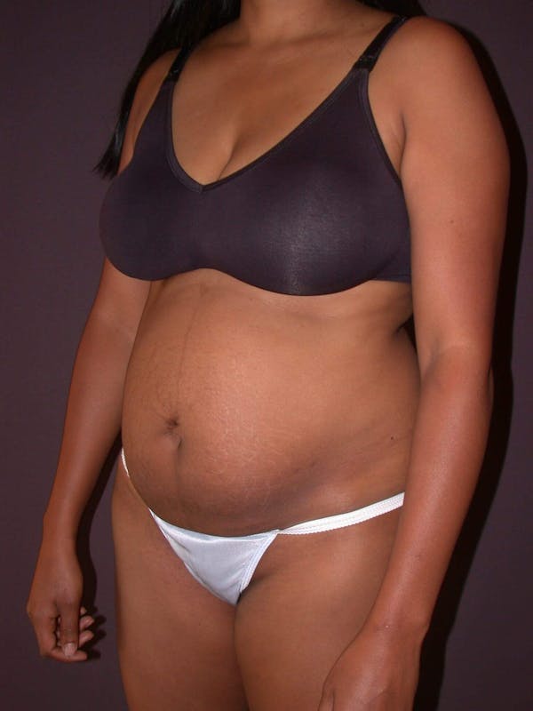Tummy Tuck Gallery Before & After Gallery - Patient 4756942 - Image 7