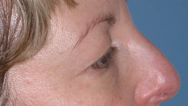 Eyelid Lift Gallery Before & After Gallery - Patient 4756943 - Image 3