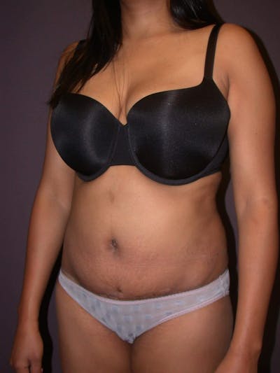 Tummy Tuck Gallery Before & After Gallery - Patient 4756942 - Image 8