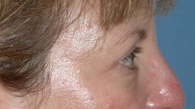 Eyelid Lift Before & After Gallery - Patient 4756943 - Image 4