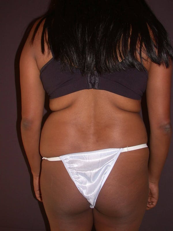 Tummy Tuck Gallery Before & After Gallery - Patient 4756942 - Image 9