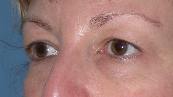 Eyelid Lift Gallery Before & After Gallery - Patient 4756943 - Image 5