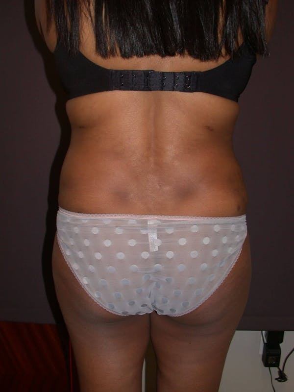 Tummy Tuck Gallery Before & After Gallery - Patient 4756942 - Image 10