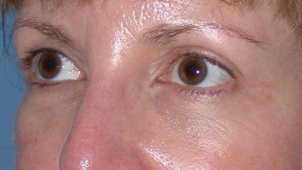 Eyelid Lift Gallery Before & After Gallery - Patient 4756943 - Image 6