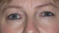 Eyelid Lift Gallery Before & After Gallery - Patient 4756946 - Image 1