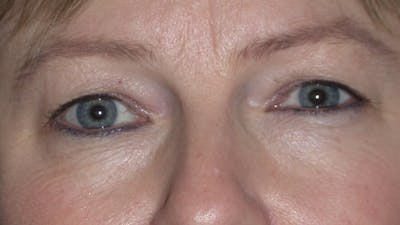 Eyelid Lift Gallery Before & After Gallery - Patient 4756946 - Image 1