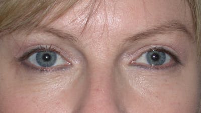 Eyelid Lift Before & After Gallery - Patient 4756946 - Image 2