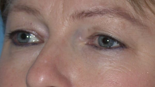Eyelid Lift Gallery Before & After Gallery - Patient 4756946 - Image 3