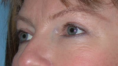 Eyelid Lift Gallery Before & After Gallery - Patient 4756946 - Image 4
