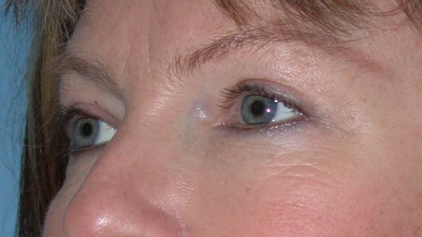 Eyelid Lift Gallery Before & After Gallery - Patient 4756946 - Image 4