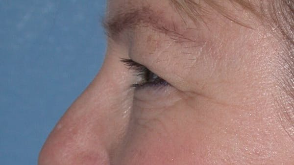 Eyelid Lift Gallery Before & After Gallery - Patient 4756946 - Image 5