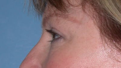 Eyelid Lift Gallery Before & After Gallery - Patient 4756946 - Image 6