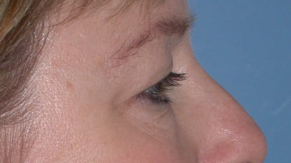 Eyelid Lift Gallery Before & After Gallery - Patient 4756946 - Image 7